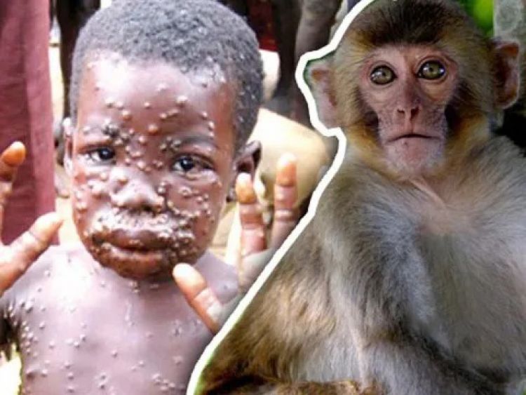 Israel confirma primer caso de viruela del mono