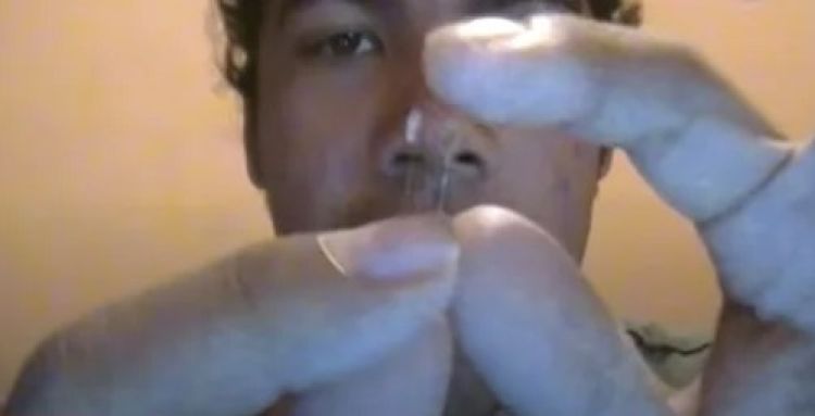 Se operó a sí mismo su nariz con un tutorial de YouTube y terminó en el hospital